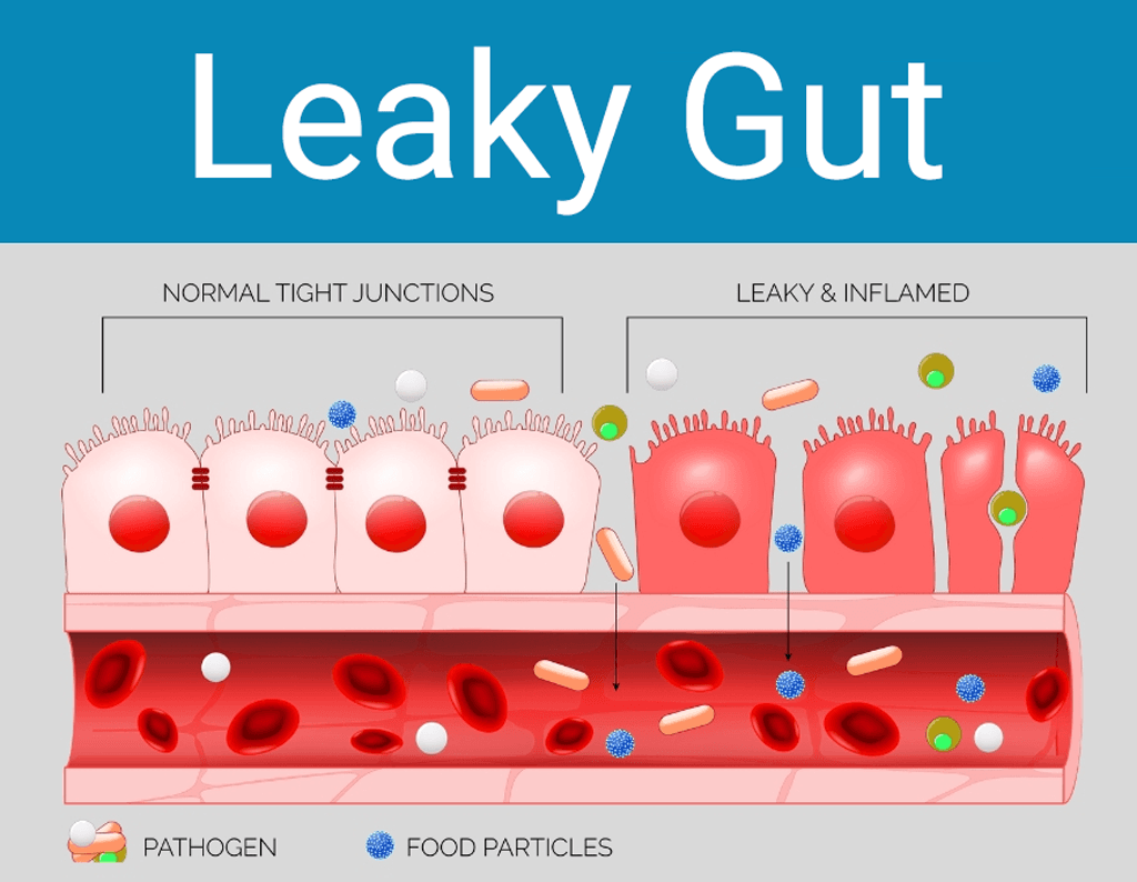 leaky gut